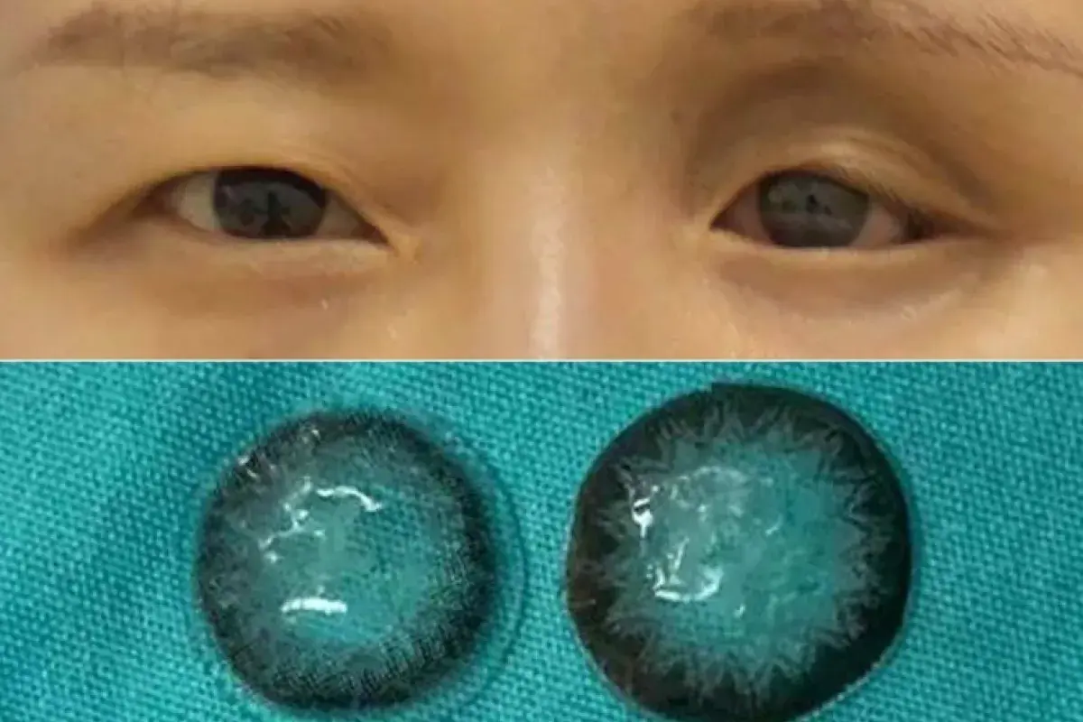 Five contact lenses found stuck behind a woman’s eyeball