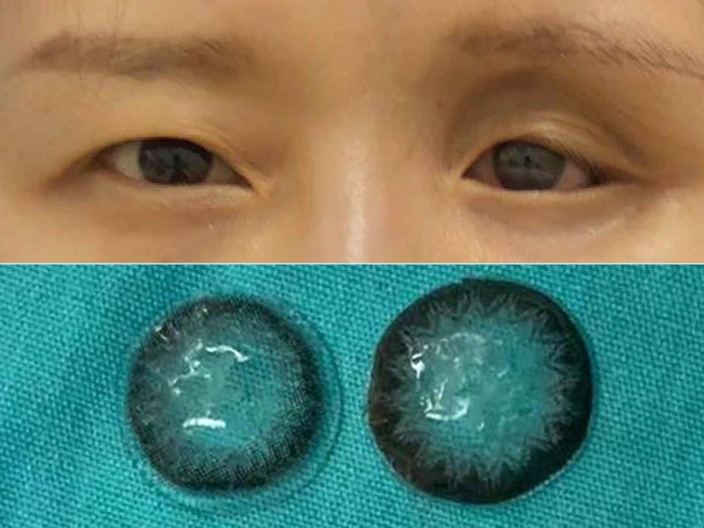 Five contact lenses found stuck behind a woman’s eyeball 🧠