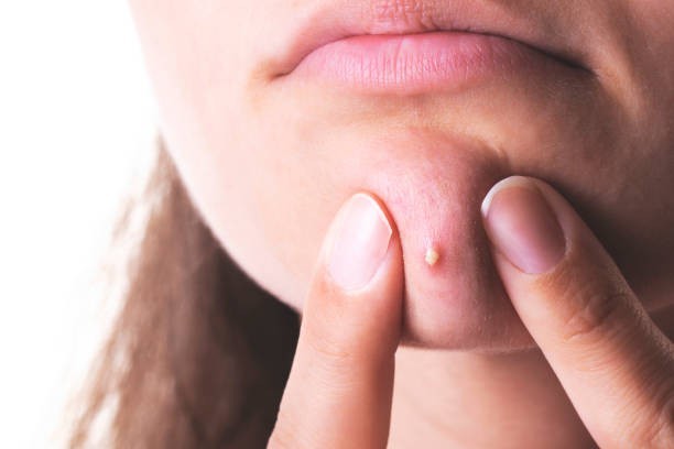 Popping pimples helps them heal faster