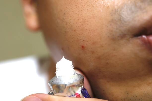 Toothpaste dries pimples overnight