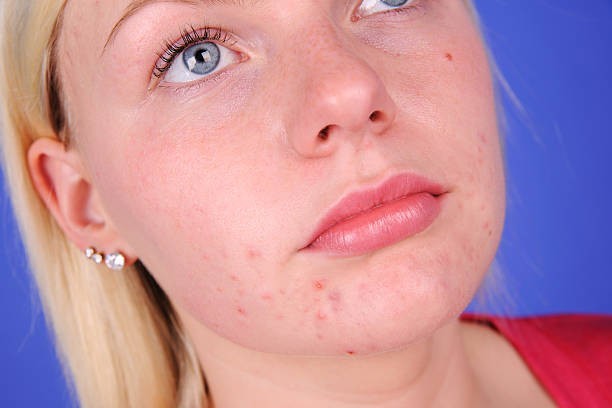 Acne will go away by itself
