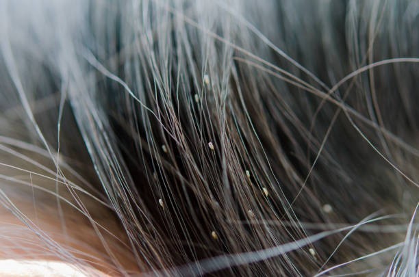 Head lice prefer clean hair