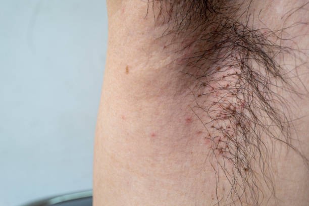 Body lice can spread disease