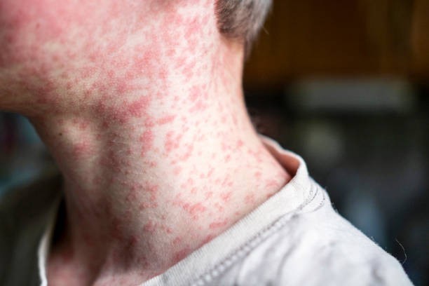 Myth 2: Natural immunity is better than vaccine-induced immunity
